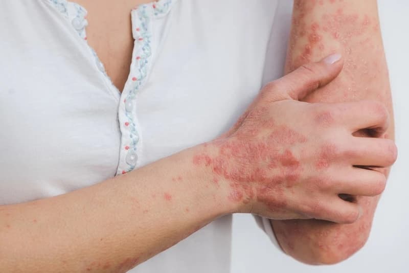 Bečki naučnici otkrili funkcionalnu metodu u terapiji neurodermatitisa