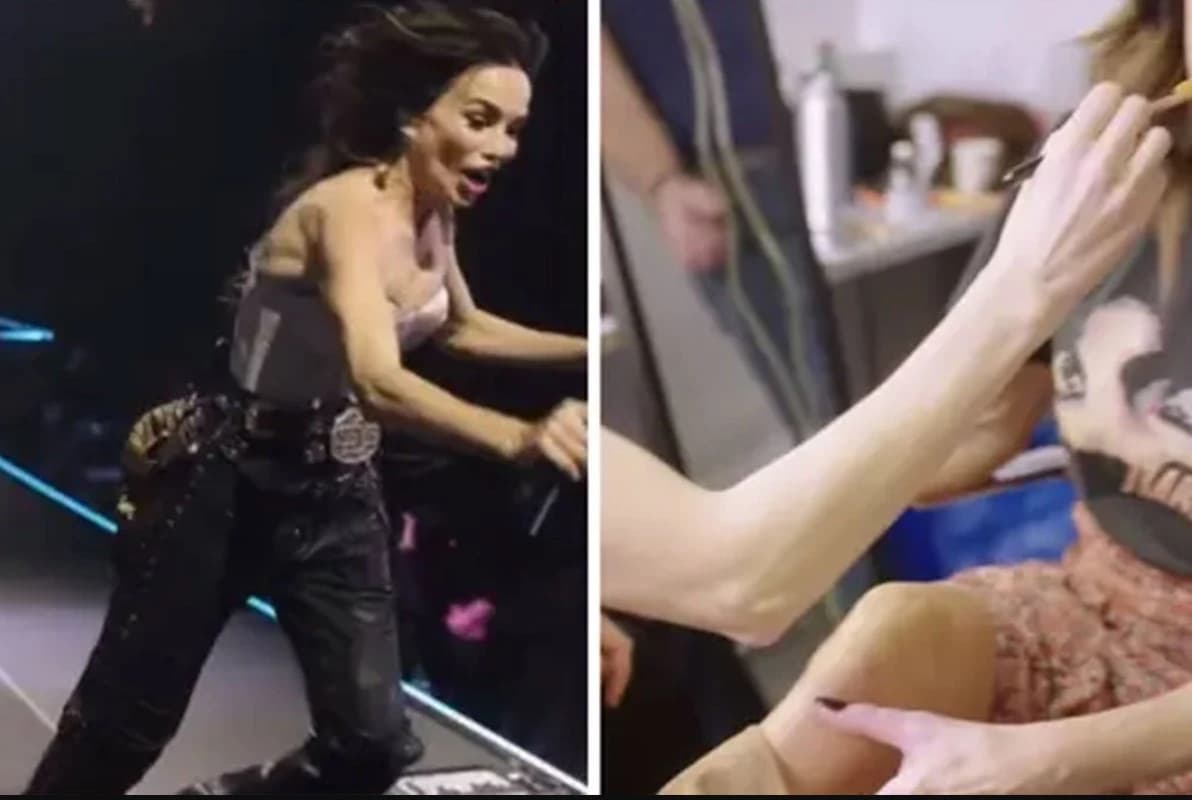 Severina pokazala modrice od pada na koncertu