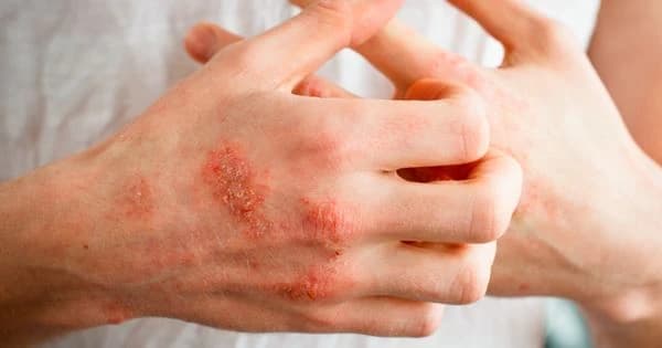 Riješite problem ispucalih ruku pomoću ovih prirodnih proizvoda