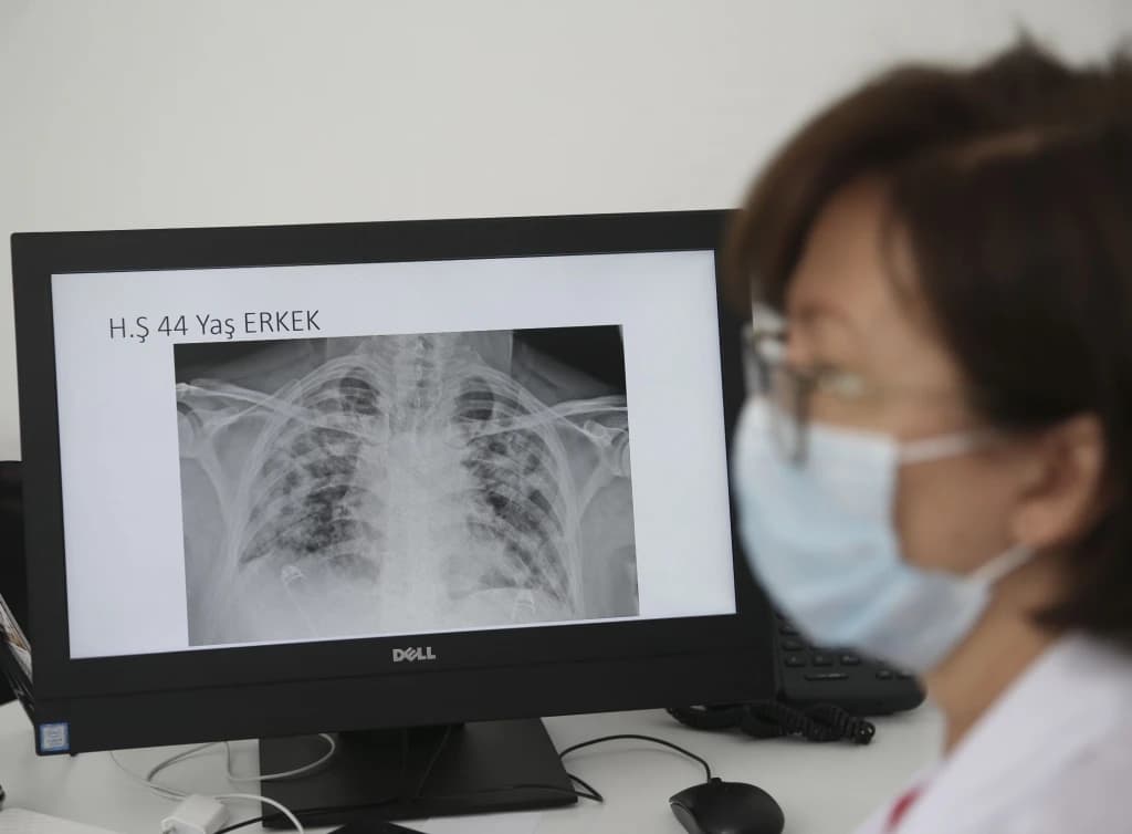 Snimci pokazuju štetu koju koronavirus izaziva na plućima
